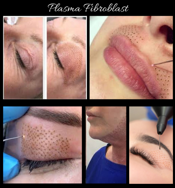 Emigrere længde Ti år Plasma Fibroblast, Plasma Pen Skin Treatments Naples, FL 
