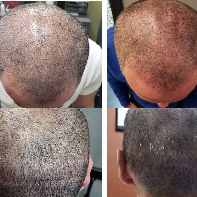 Scalp Micropigmentation in Naples fl Scalp Micropigmentation in Naples fl