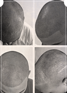 Scalp Micropigmentation Naples, FL