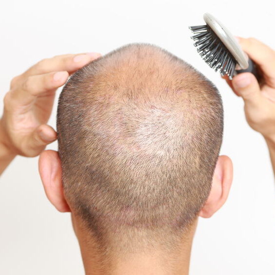 Hair Restoration PRP Hair Restoration PRP