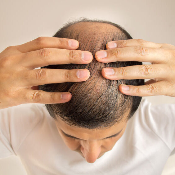Scalp Micropigmentation Scalp Micropigmentation