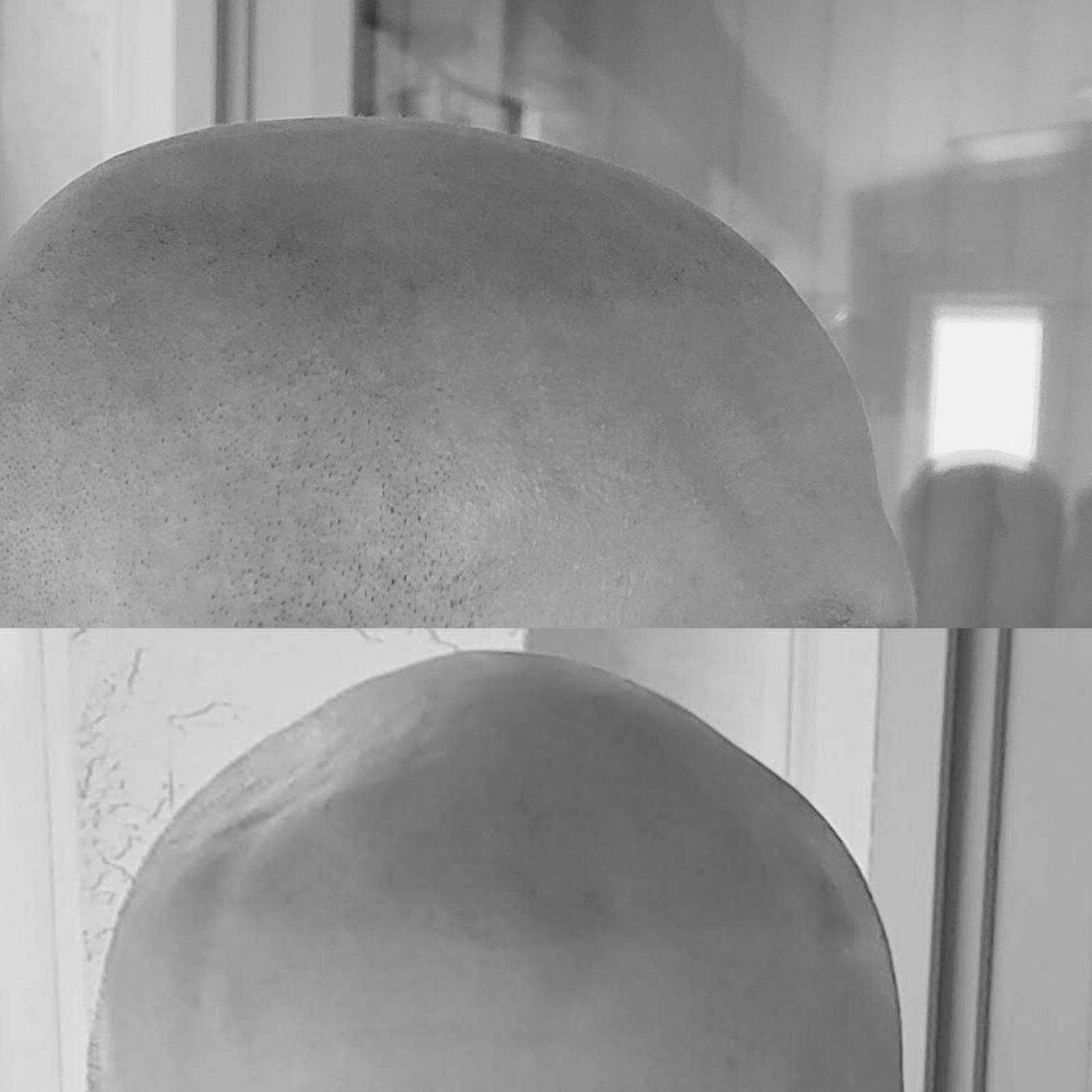 1st Advanced Microneedling PRP Hair Restoration Treatment (17) Scalp Micropigmentation Naples, FL