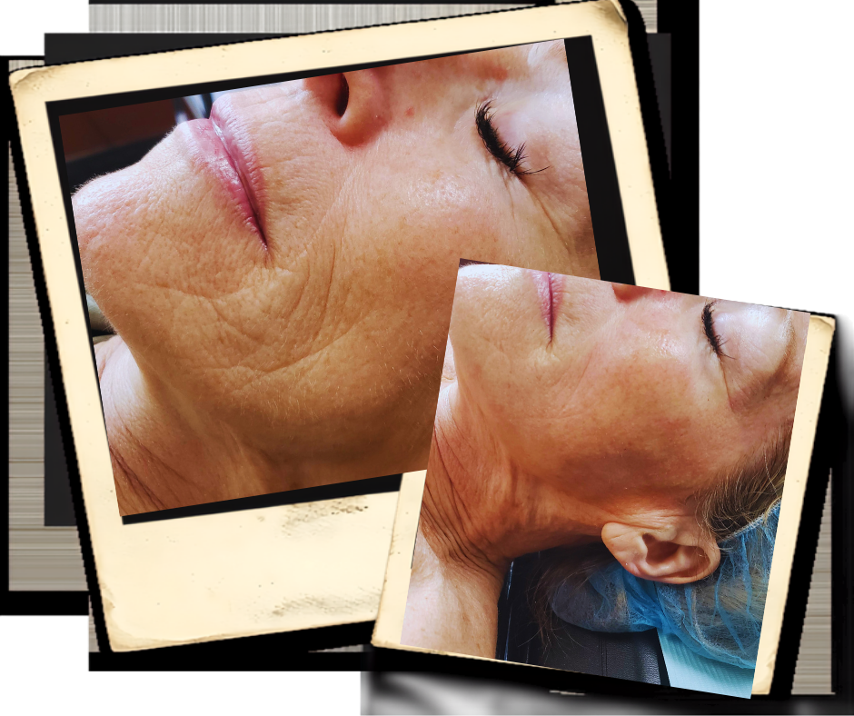 Fractional Microneedling RF Vintage Lashes and beauty Services Naples fl
