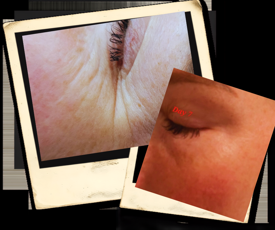 Plasma Fibroblast Naples fl Vintage Lashes and Beauty Services