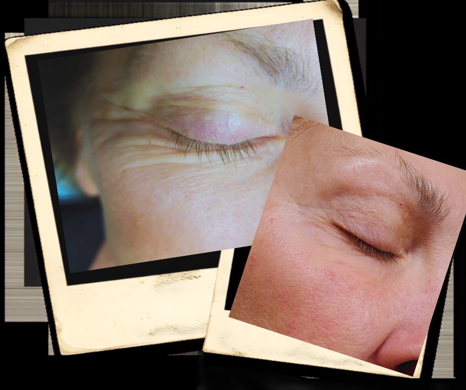 Plasma Pen Vintage Lashes and Beauty Services of Naples FL